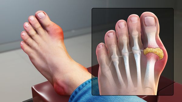 Dieta për acidin urik: çfarë thonë studimet dhe si ta aplikoni këtë javë