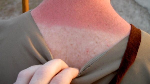 Skuqja dhe kruarja pas diellit mund të jenë alergji