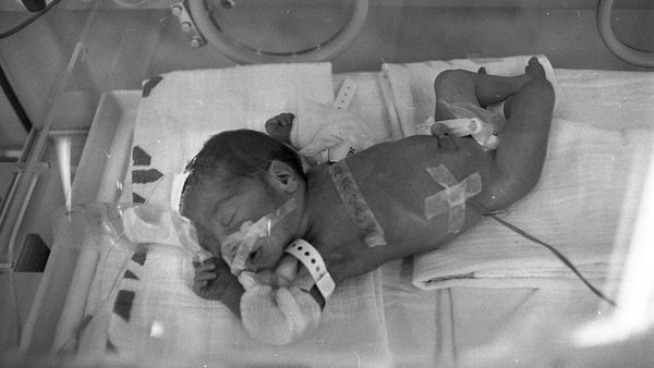 Sa e rrallë është teratoma që u largua nga foshna e një të porsalinduri në Kosovë?