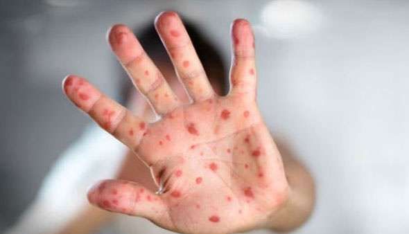 Vaksinimi kundër fruthit vetëm 65 përqind