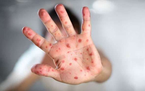 Vaksinimi kundër fruthit vetëm 65 përqind